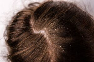 Dry hair treatment Pembroke Pines. Dry Scalp Treatment