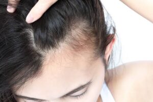 Hair loss treatment Pembroke Pines. Scalp Treatment Broward county.