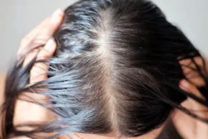 Hair loss treatment near me. Scalp treatment Broward county.